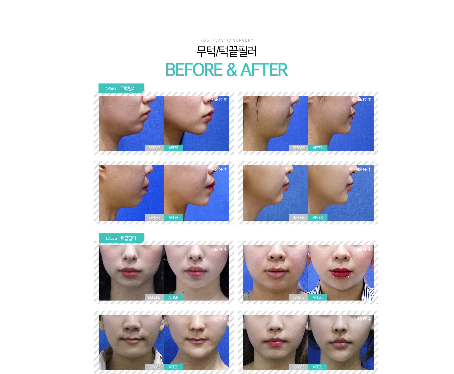 KODI PLASTIC SURGERY 무턱/턱끝필러 BEFORE&AFTER
